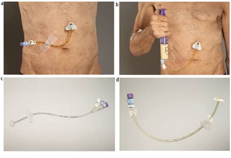 pegogram|Percutaneous endoscopic gastrostomy